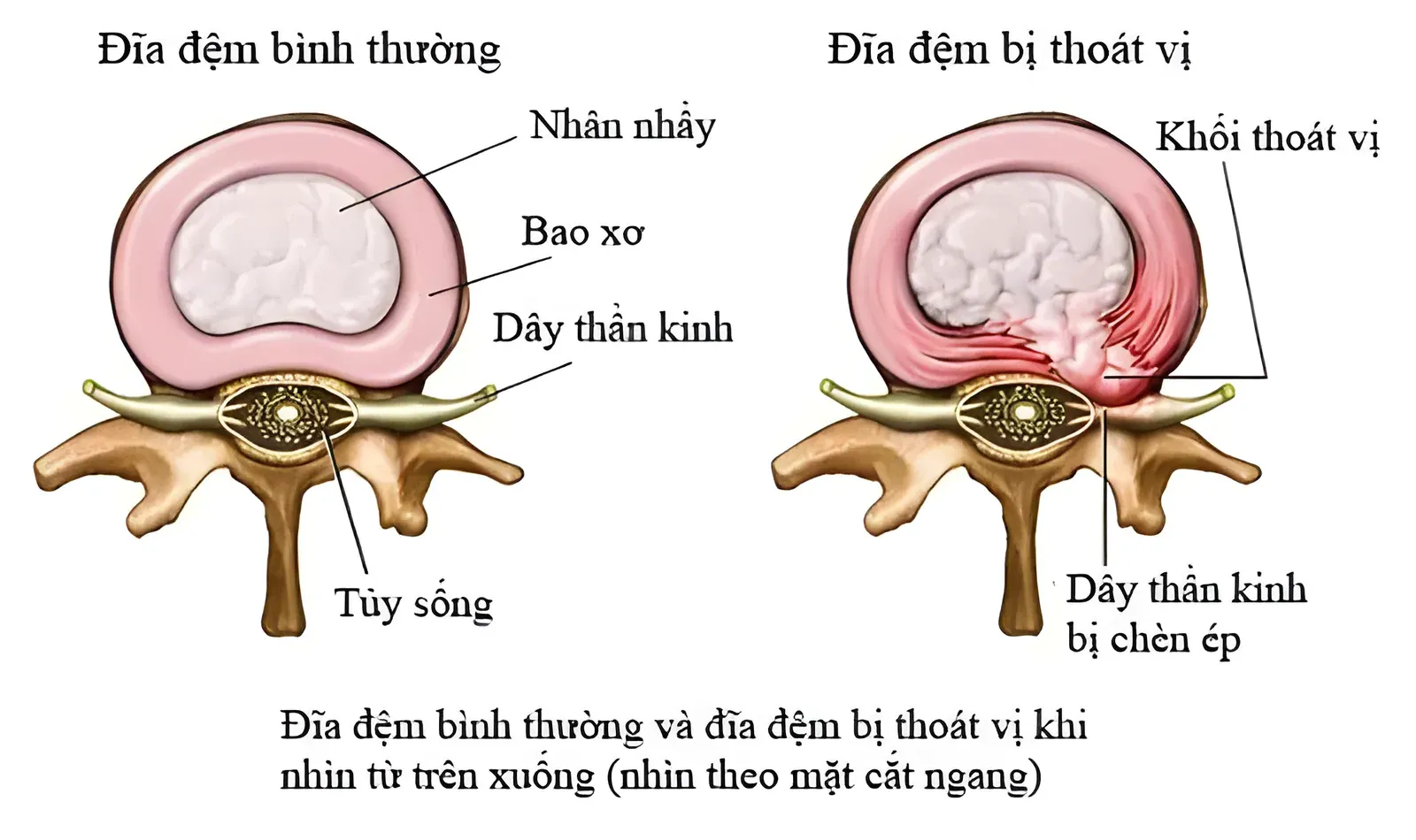 Thoát vị đĩa đệm - hình chụp mặt cắt đĩa đệm khi bình thường và khi bị thoát vị