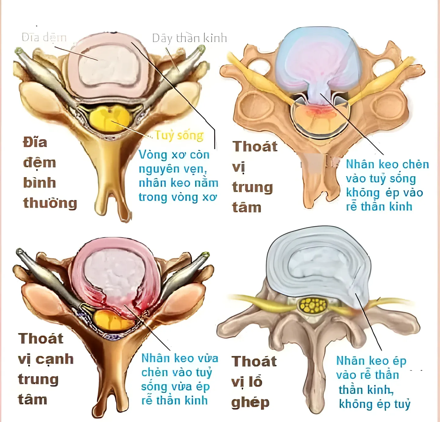 Hướng thoát vị của nhân nhầy và mức độ ảnh hưởng đến rễ thần kinh