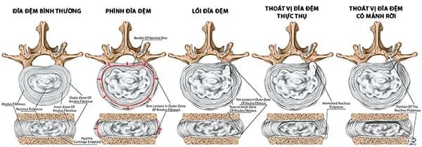Các hình thái thoát vị đĩa đệm trên phim MRI: lồi đĩa, thoát vị và mảnh rời