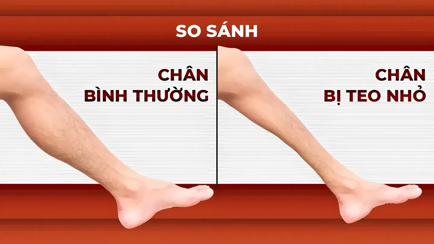 Teo cơ là một trong những dấu hiệu thoát vị đĩa đệm nguy hiểm cần đi khám ngay