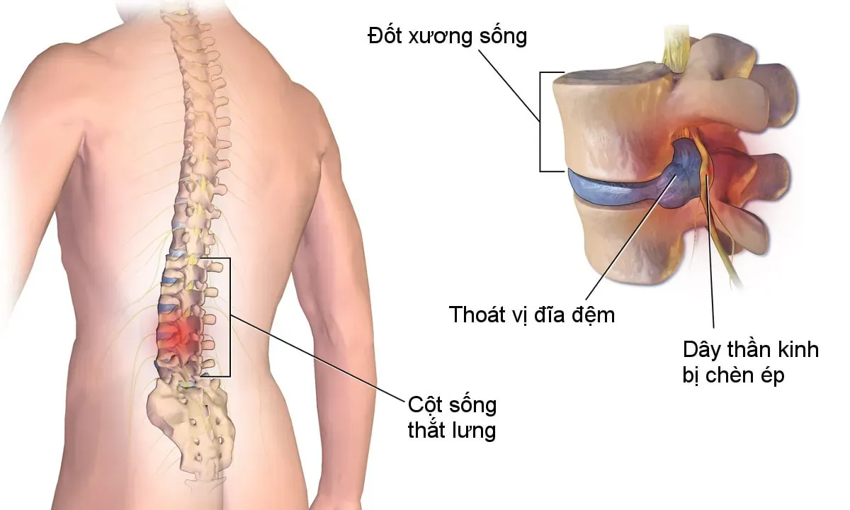 Hình ảnh mô phỏng thoát vị đĩa đệm cột sống thắt lưng
