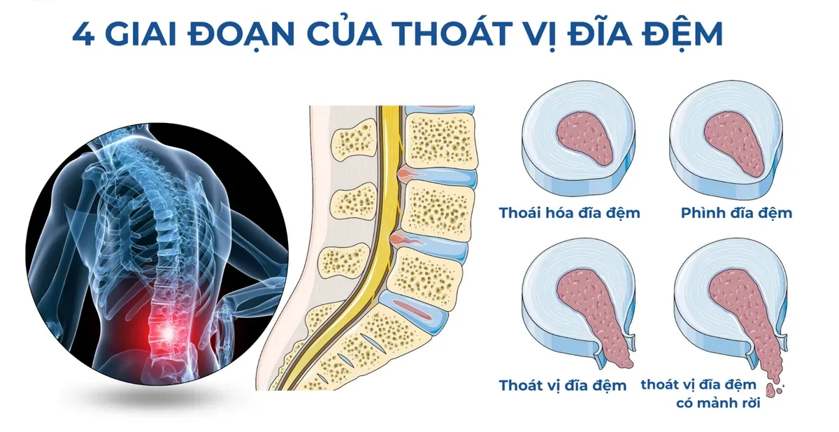 4 giai đoạn của thoát vị đĩa đệm cột sống thắt lưng