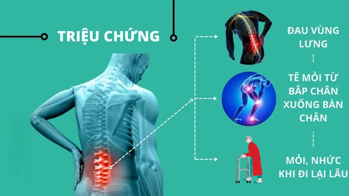 Triệu chứng của thoát vị đĩa đệm cột sống thắt lưng