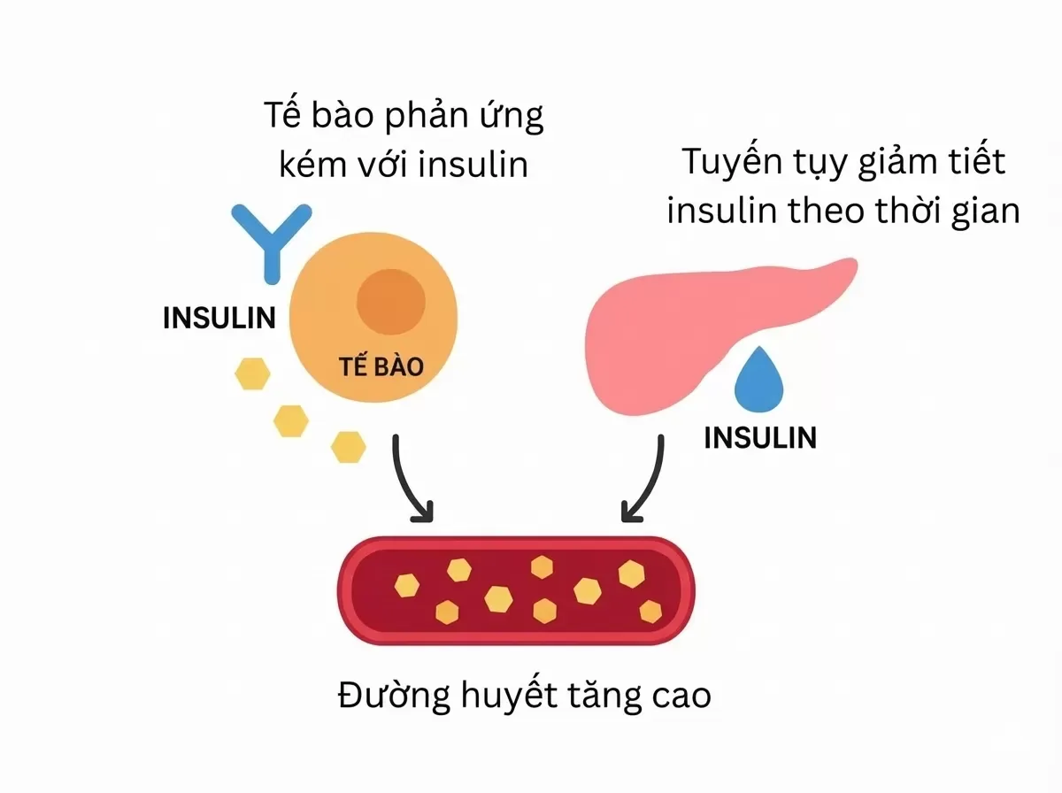 Tiểu đường tuýp 2 là gì? Tiểu đường tuýp 2 xảy ra khi cơ thể không sử dụng insulin hiệu quả hoặc