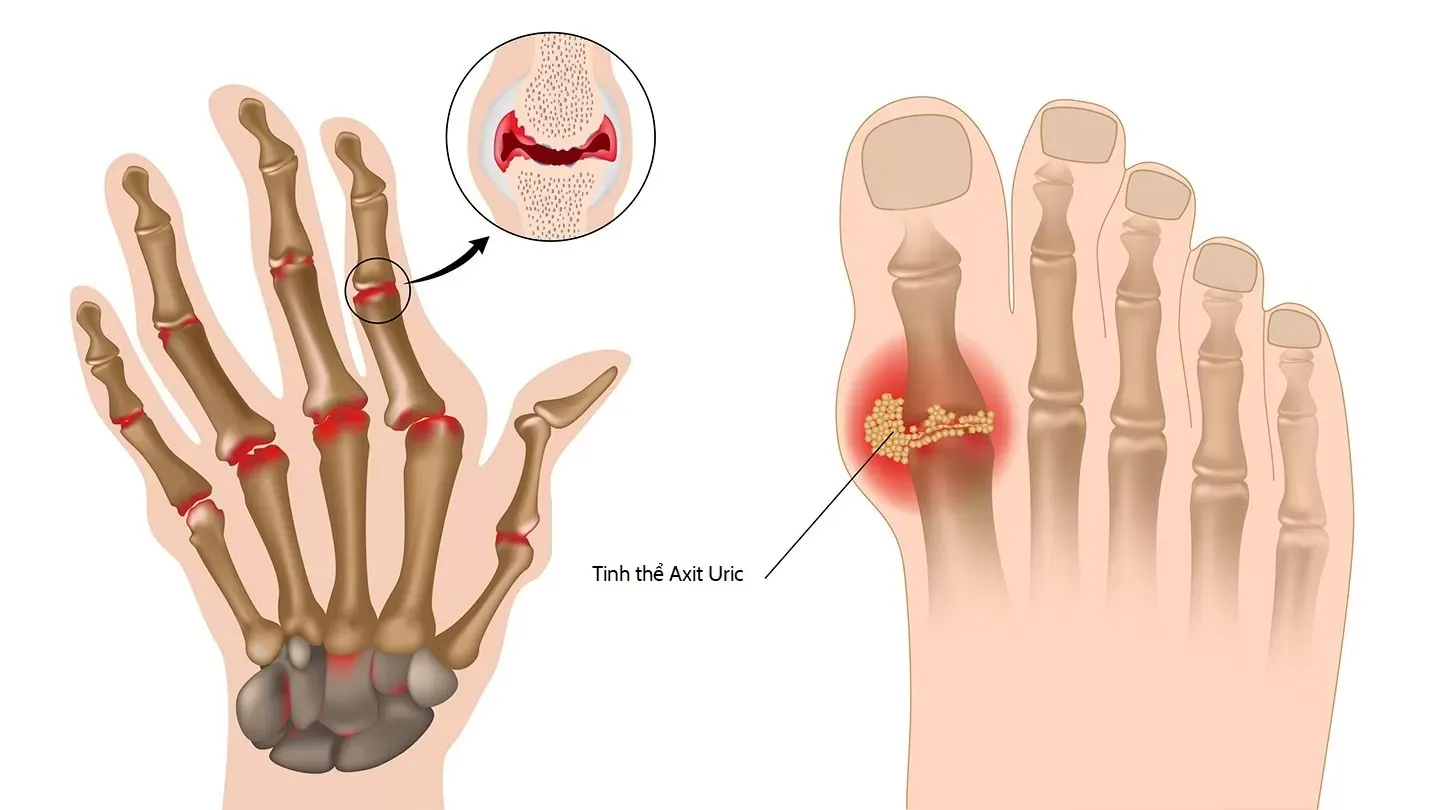 Bệnh gút có thể gây nên biến chứng sâu sắc ở các khớp và hệ tiết niệu do nồng độ acid uric quá cao