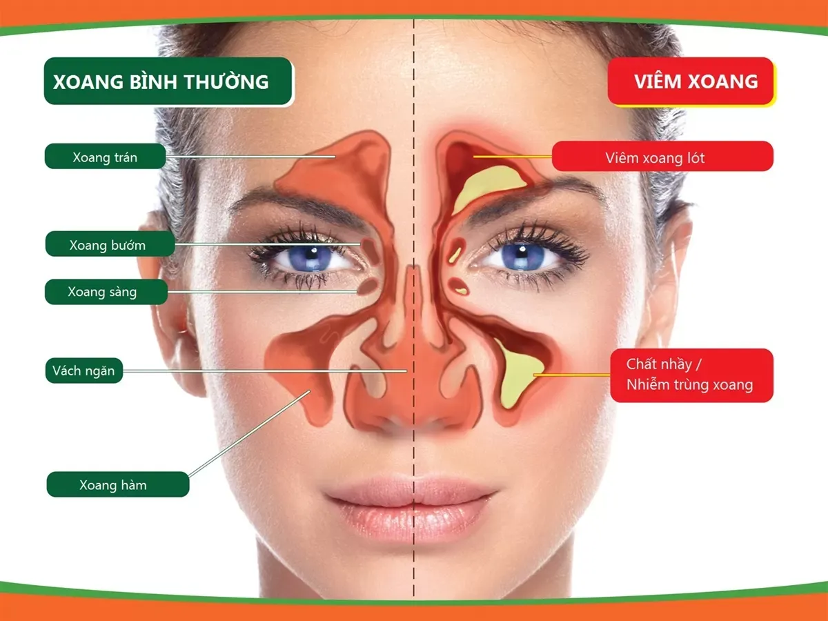 Viêm xoang